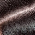 easy home remedies for dandruff