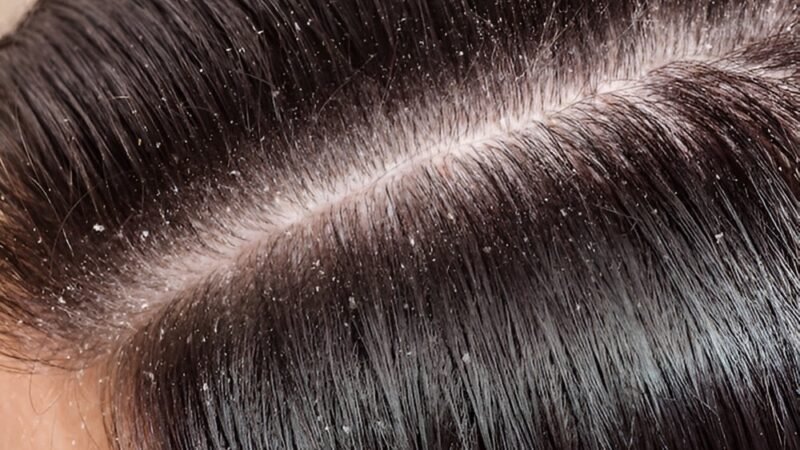 7 Easy Home Remedies for Dandruff Treatment