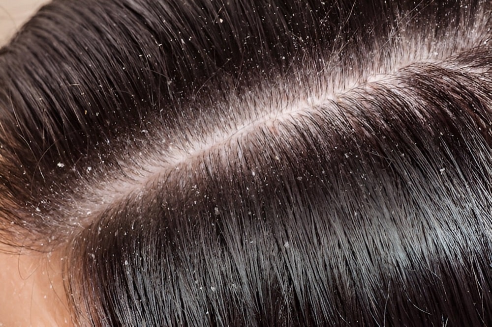 7 Easy Home Remedies for Dandruff Treatment