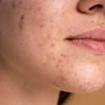 reduce acne marks at home