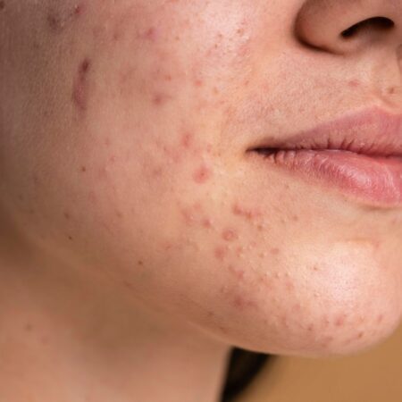 5 Best Ways to Reduce Acne Marks at Home in 2025