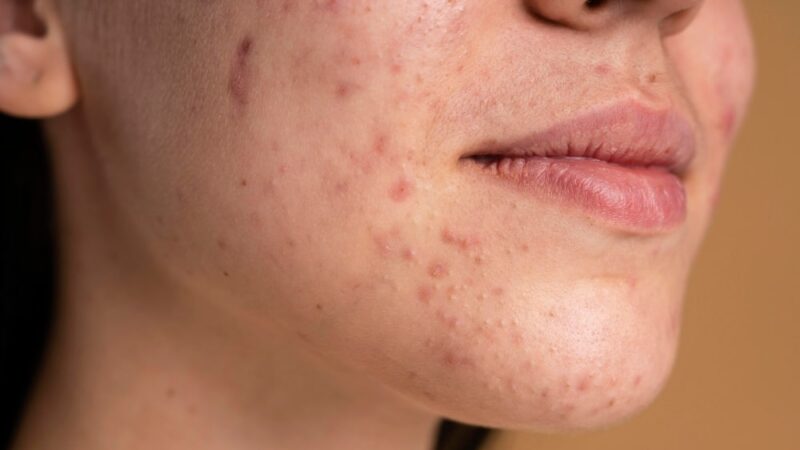 5 Best Ways to Reduce Acne Marks at Home in 2025