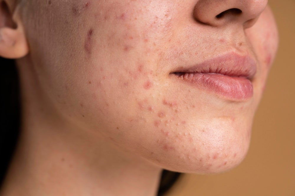 5 Best Ways to Reduce Acne Marks at Home in 2025